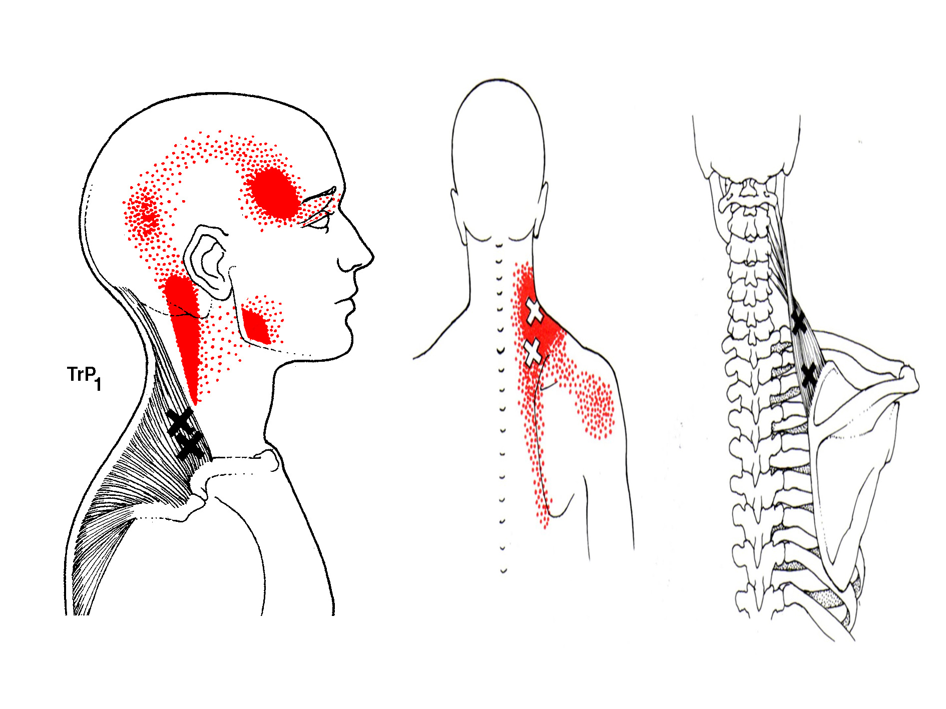 trigger points